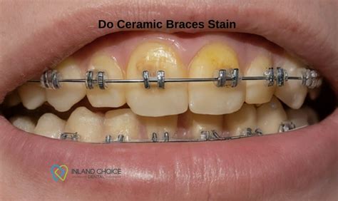 do ceramic brackets stain